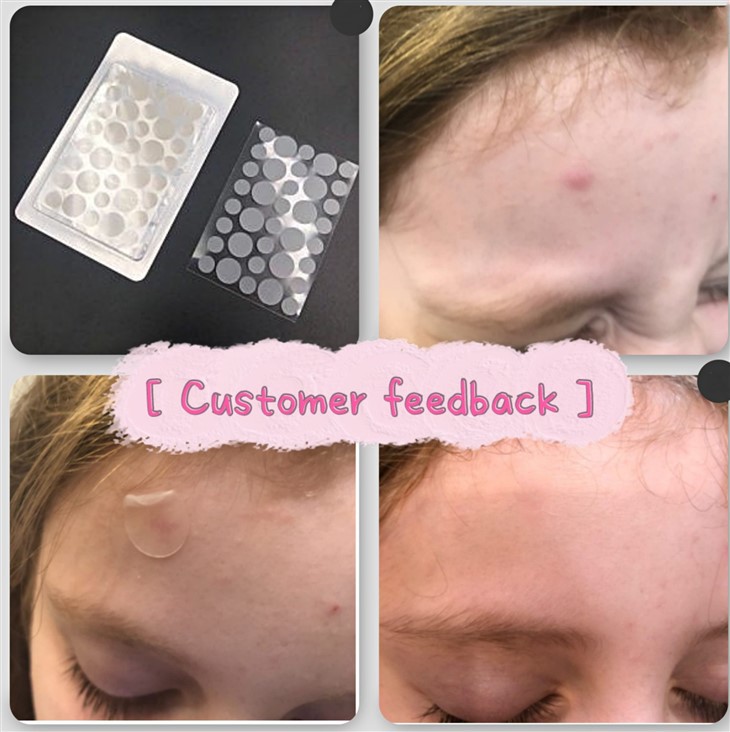 Salicylic Acid Zit Patch
